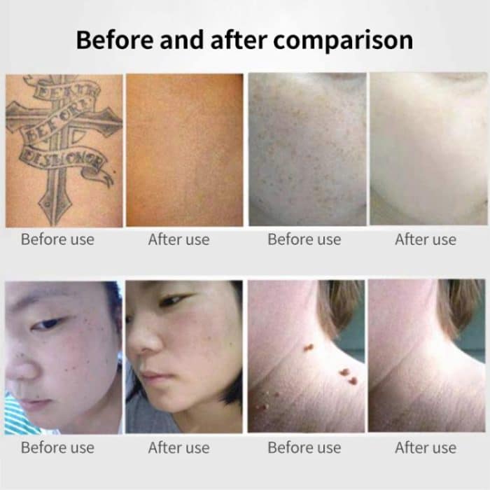 AA-A401 Portable Laser Beauty Instrument Mole Removal Freckle Removal Beauty Laser Pen, Red Light Plug-in, Blue Light Plug-in – Bild 8