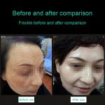 Tragbare Pikosekunden-Handheld-Maschine (Entfernung von Augenbrauen-Tätowierungsflecken), Laser-Plasma-Schönheitspflegestift, EU-Stecker, USB / Blue Light, USB /  Red Light – Bild 4