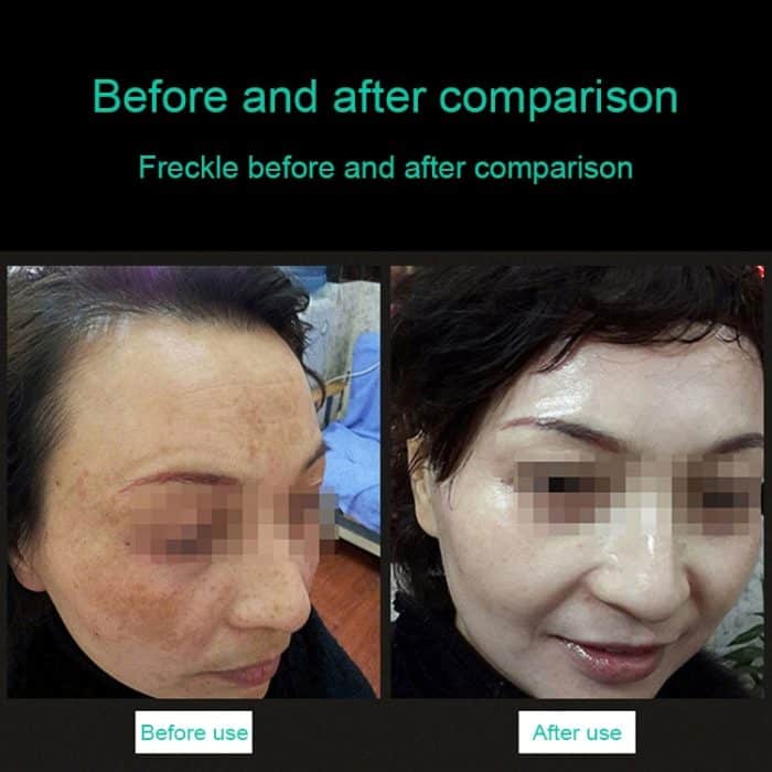 Tragbare Pikosekunden-Handheld-Maschine (Entfernung von Augenbrauen-Tätowierungsflecken), Laser-Plasma-Schönheitspflegestift, EU-Stecker, USB / Blue Light, USB /  Red Light – Bild 4