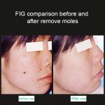 Tragbare Pikosekunden-Handheld-Maschine (Entfernung von Augenbrauen-Tätowierungsflecken), Laser-Plasma-Schönheitspflegestift, EU-Stecker, USB / Blue Light, USB /  Red Light – Bild 6