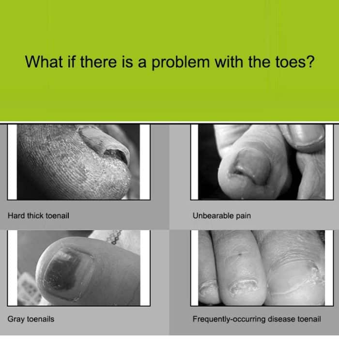 2-in-1-Nagelknipser für Paronychie, Olekranon-Nagelzange aus Edelstahl und Heber für eingewachsene Nägel – Bild 9