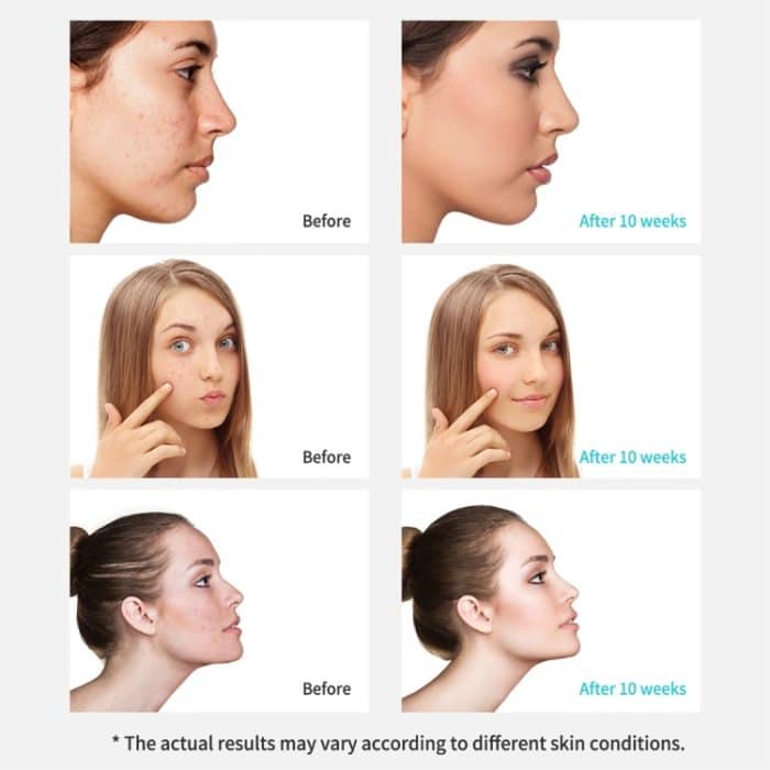 Xpreen wiederaufladbare Porenreiniger Home Facial Beauty Device mit LED-Bildschirm und 4 Sonden – Bild 11