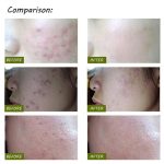 K-SKIN KD-7910 Akne-Laserstift Tragbare Faltenentfernungsmaschine Langlebiges Gerät zur Entfernung weicher Narben Blaulicht-Therapiestift – Bild 14