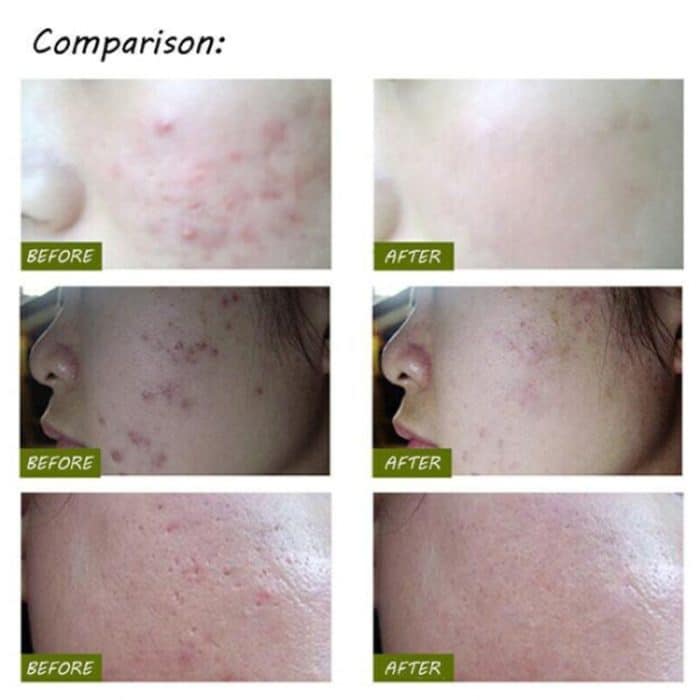 K-SKIN KD-7910 Akne-Laserstift Tragbare Faltenentfernungsmaschine Langlebiges Gerät zur Entfernung weicher Narben Blaulicht-Therapiestift – Bild 14