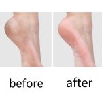 10 PCS Pediküre Messer für tote Haut Schwielen – Bild 6