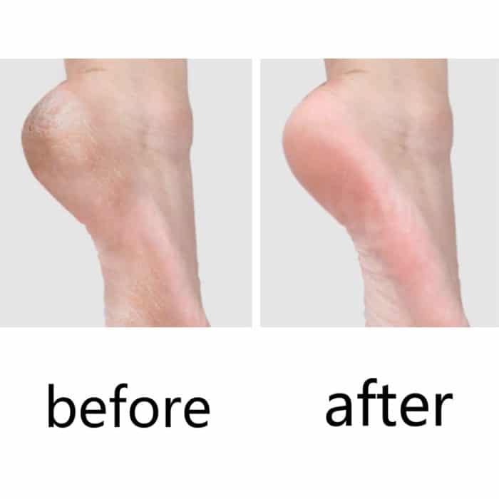 10 PCS Pediküre Messer für tote Haut Schwielen – Bild 6