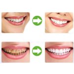 2 PCS Thermoforming Dental Mundschutz Zahnaufhellungsschalen Mundpflege – Bild 6