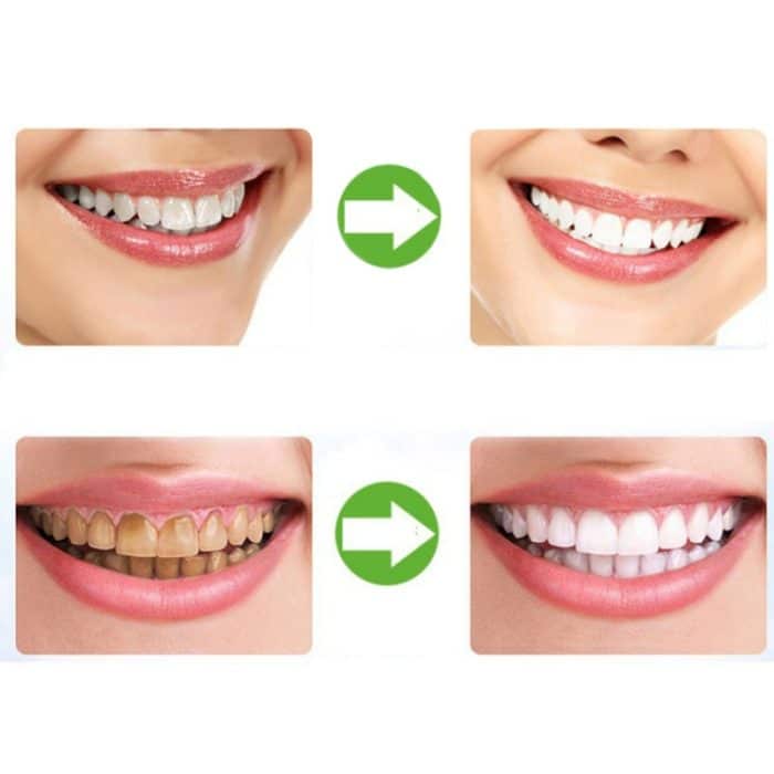 2 PCS Thermoforming Dental Mundschutz Zahnaufhellungsschalen Mundpflege – Bild 6