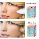 Dunkelfleckentferner USB Laser Plasma Pen Gesichts Sommersprossen Warzenentfernung Beauty Care Device – Bild 15