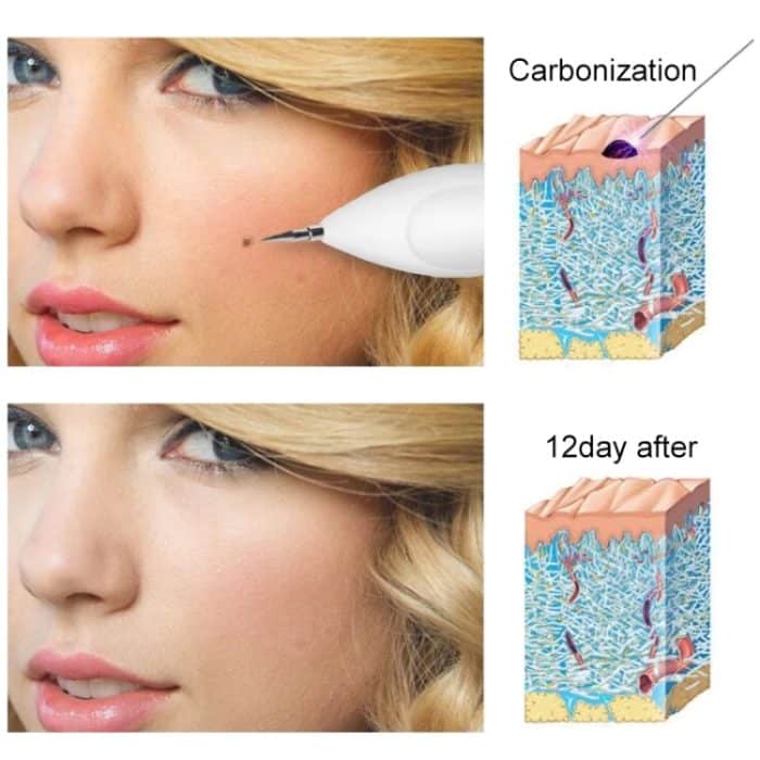 Dunkelfleckentferner USB Laser Plasma Pen Gesichts Sommersprossen Warzenentfernung Beauty Care Device – Bild 15