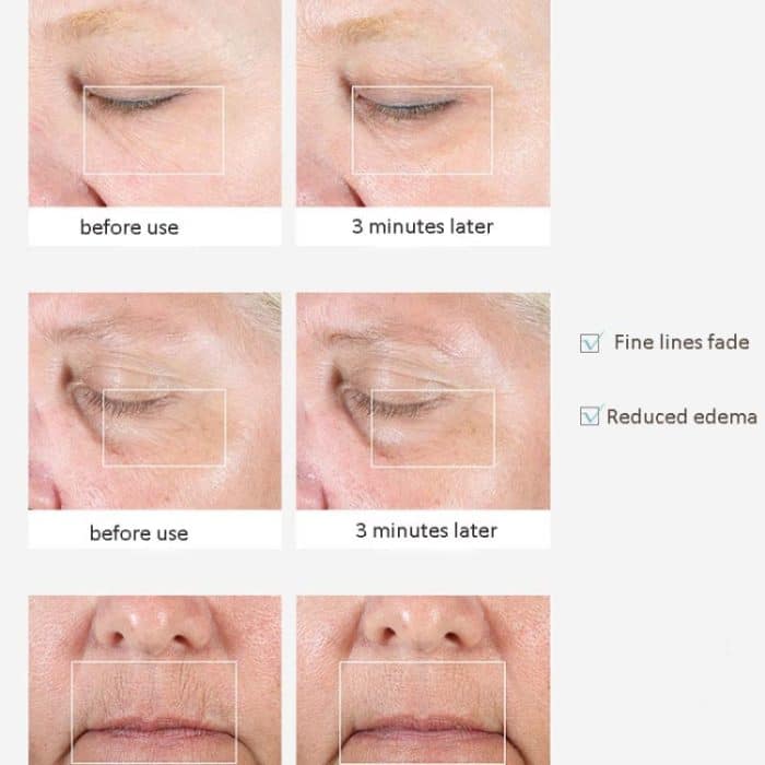 2-teiliges Augen- und Lippenmassagegerät zum Verdünnen der Tränensäcke ohne Batterie – Bild 6