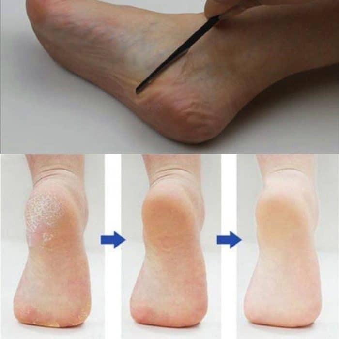 Pediküre Maniküre Nagelreiniger Nagelhautpflege Dead Skin Planer Beauty Fußpflege-Tool – Bild 2