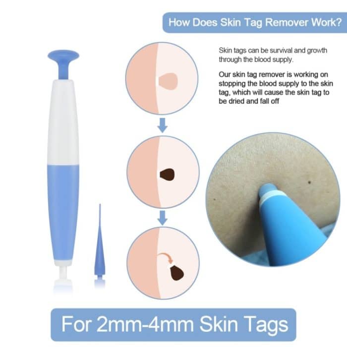 Werkzeug zum Entfernen von Hautmarkierungen für 2 mm bis 4 mm große Hautmarkierungen, Skin Tag Removal Tool, With  Acne Patch – Bild 2