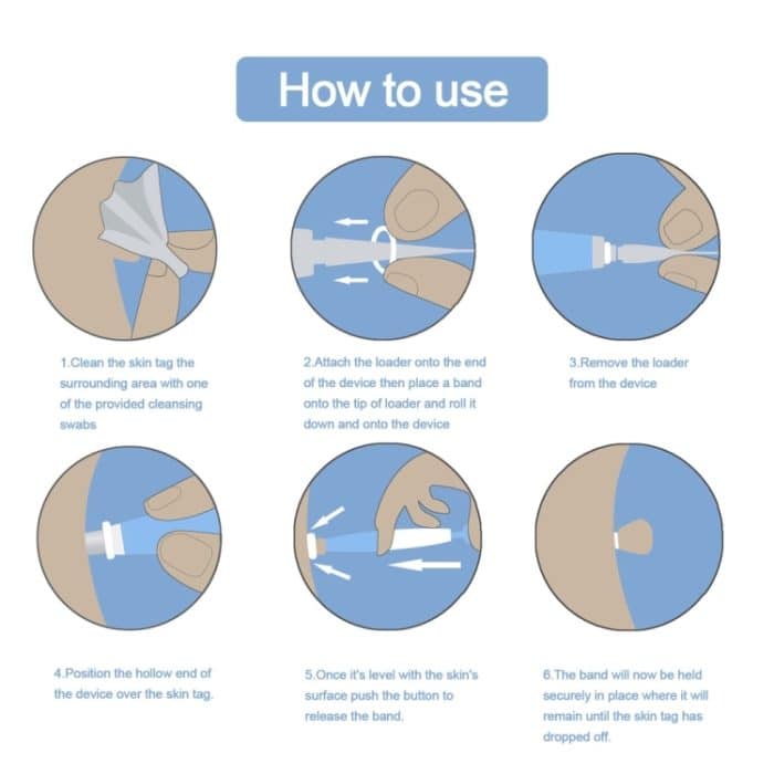 Werkzeug zum Entfernen von Hautmarkierungen für 2 mm bis 4 mm große Hautmarkierungen, Skin Tag Removal Tool, With  Acne Patch – Bild 4