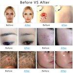 AA-A401 Kleiner Stift zur Entfernung von Sommersprossen und Muttermalen, Tattoo- und Augenbrauenentfernungs-Schönheitsinstrument, Red Light Plug-in, Blu-ray Plug-in, Red Light Battery, Blu-ray Battery – Bild 10