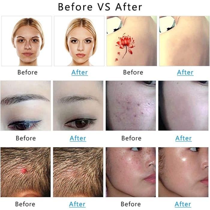 AA-A401 Kleiner Stift zur Entfernung von Sommersprossen und Muttermalen, Tattoo- und Augenbrauenentfernungs-Schönheitsinstrument, Red Light Plug-in, Blu-ray Plug-in, Red Light Battery, Blu-ray Battery – Bild 10