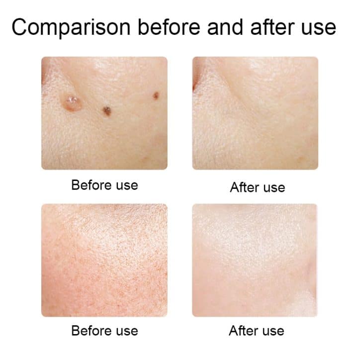 FY-106 Tragbarer Stift zur Entfernung von Muttermalen und Sommersprossen Haushaltslaser-Schönheitsgerät, FY-106 (Rose Gold), FY-106 (Gold), FY-106 (Green), FY-106 (Blue) – Bild 9