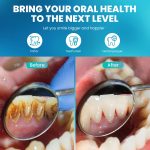 Ultraschall-Zahnsteinentfernungs-Zahnsteinentferner, Heim-Zahnreinigungsinstrument – Bild 5