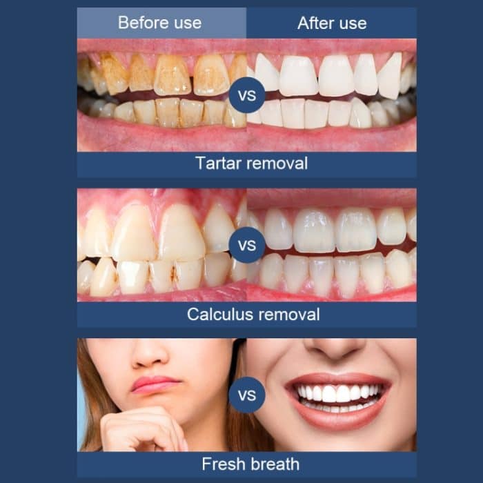 Ultraschall-Elektro-Scaler Home Dental Cleaner Tragbares Scaling-Instrument – Bild 7