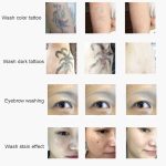 Laser-Tätowierungsentfernungsmaschine Nicht-invasive Augenbrauenwasch-Schönheitsausrüstung – Bild 8