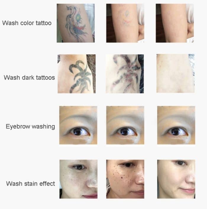 Laser-Tätowierungsentfernungsmaschine Nicht-invasive Augenbrauenwasch-Schönheitsausrüstung – Bild 8