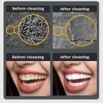 Elektrischer Ultraschall-Zahnsteinentferner, Zahnbelagreiniger, Zahnsteinentfernung mit LED-Licht, Package A, Package B, Package A with Accessories, Pacakge B with Accessories – Bild 7