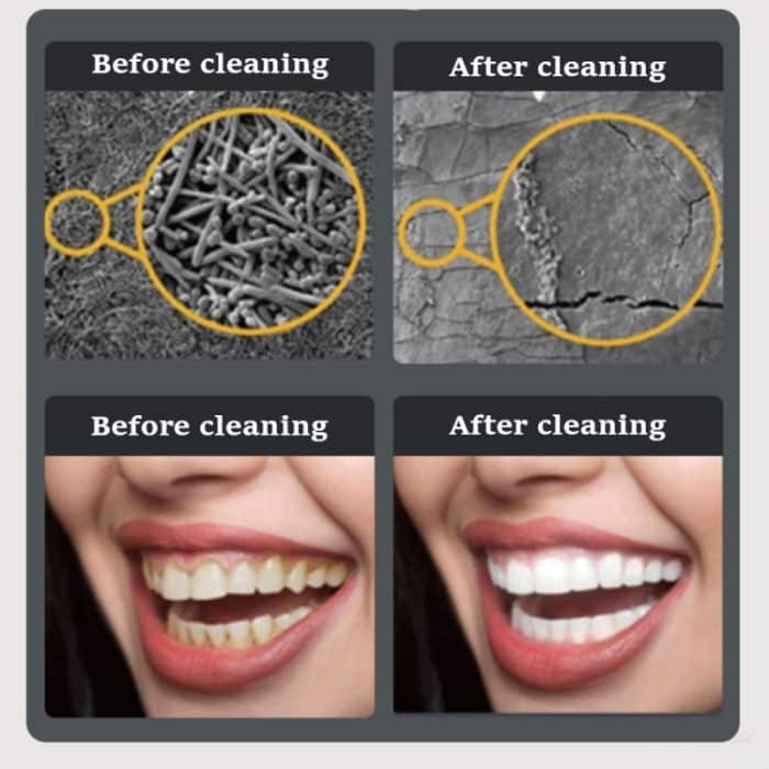 Elektrischer Ultraschall-Zahnsteinentferner, Zahnbelagreiniger, Zahnsteinentfernung mit LED-Licht, Package A, Package B, Package A with Accessories, Pacakge B with Accessories – Bild 7