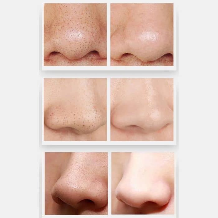 ZLY-018 Elektrisches Mitesser-Sauggerät für den Haushalt, Porenreinigungs- und Schönheitsausrüstung, ZLY-018 – Bild 7