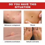 EELHOE 30 ml/Flasche Anti-Maulwurf- und Warzenflüssigkeit, Dark Spot Tag Remover Skin Essence – Bild 4