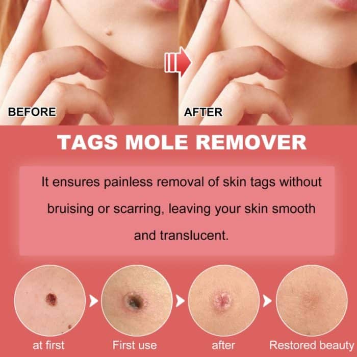 EELHOE 30 ml/Flasche Anti-Maulwurf- und Warzenflüssigkeit, Dark Spot Tag Remover Skin Essence – Bild 7