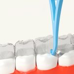 Fawnmum Zahnspangenentferner, unsichtbarer kieferorthopädischer Entfernungshaken – Bild 2