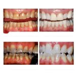 Professionelles Nano Teeth Whitening Oral Cleansing Set – Bild 5