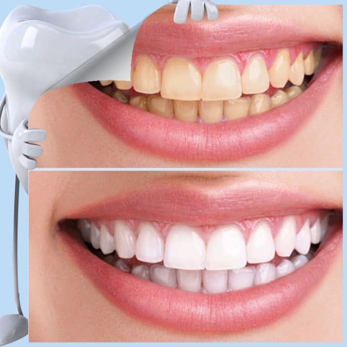 Professionelles Nano Teeth Whitening Oral Cleansing Set – Bild 7